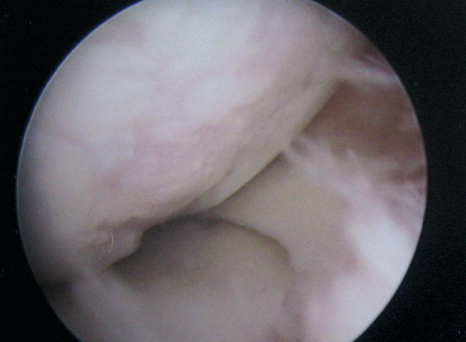 In arthroscopy posterior horn of ML appeared damaged of lack of a certain MRI diagnosis, OE is crucial. Injuries of the cartilage are a complicated problem in the diagnostics of knee injuries.