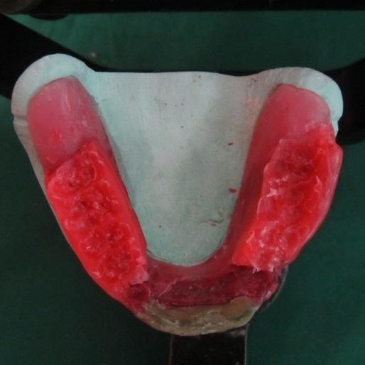 Fig. 13. The lower compound cuspal path is used as a base for generating wax cuspal path that will determine the shape of occlusal surfaces Fig. 14.