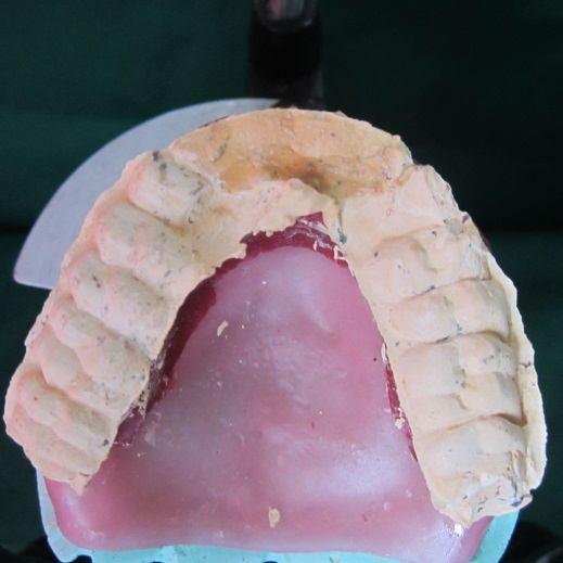 The completed dentures will exhibit balanced occlusion and function in all excursions of the mandible relation to the upper lip line and to approach balanced occlusion in centric relation as well as
