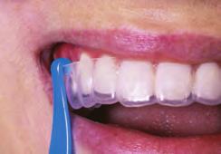 the arch. Do not use excessive force to try and remove the retainer or aligner.
