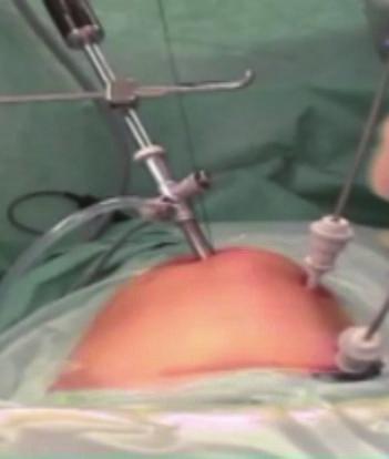 2 ISRN Minimally Invasive Surgery Laparoscope holder Lifting Loop suture Figure 1: Lift-assisted laparoscopy and solo surgery.