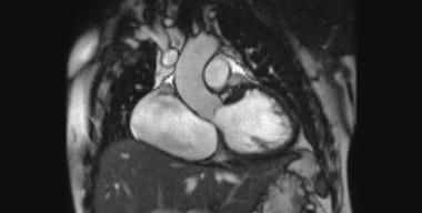 coronary plaque and stenosis as well as identify other coronary and vascular anomalies. Among the most advanced techniques available today is Cardiac MRI.