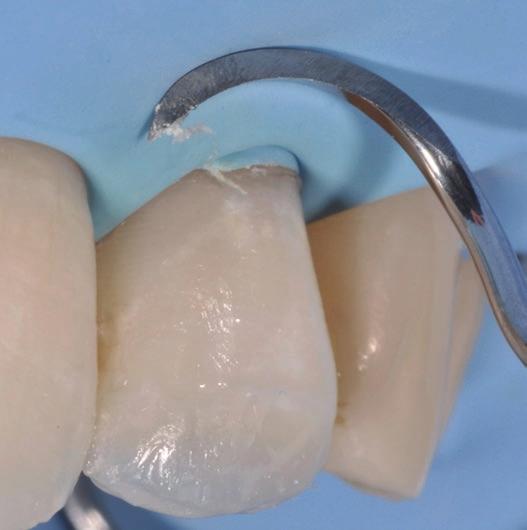 The flexibility of the Fissura enables the gentle probing possible excess bonding resins on the tooth surfaces.