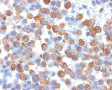 The significance of monoclonal plasma cells in