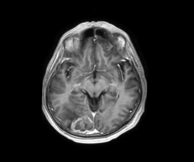 a) Pretreatment: lesion in the right occipital lobe (PTV1) b) Pretreatment: lesions in the right hemi-pons (PTV2) and right temporal lobe (PTV3) Figure 1.
