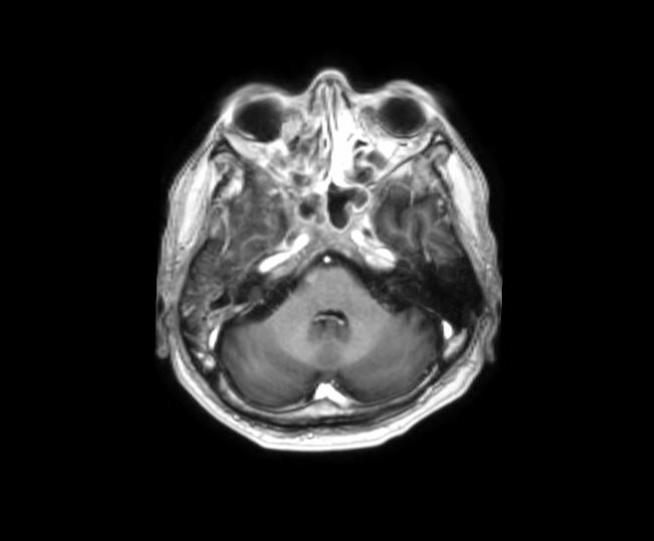 The MRI also revealed a smaller enhancing dural nodule (0.7 x 0.6 cm) in the temporal lobe located in the floor of the right middle cranial fossa, with surrounding edema, and an intra-axial node (0.
