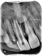 2. CASE REPORTS Case 1 A 32-year-old female patient reported to the Department of Conservative Dentistry and Endodontics, Faculty of Dental Sciences, Bangalore with the complaint of pain and swelling