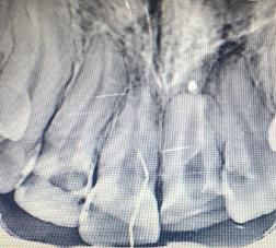 Fig. 7 Intra oral periapical radiograph Fig. 11 Postoperative 3. DISCUSSIONS Fig. 8 Working length determination Fig. 9 Mineral trioxide aggregate placed in the tooth Fig.