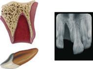 IADT guidelines for avulsed permanent teeth 89 Avulsion of permanent teeth is seen in 0.5 3% of all dental injuries (1, 2).