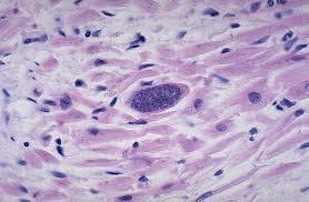 Toxoplasma gondii infection can also occur in
