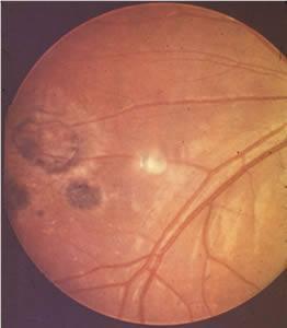 Ocular toxoplasmosis: