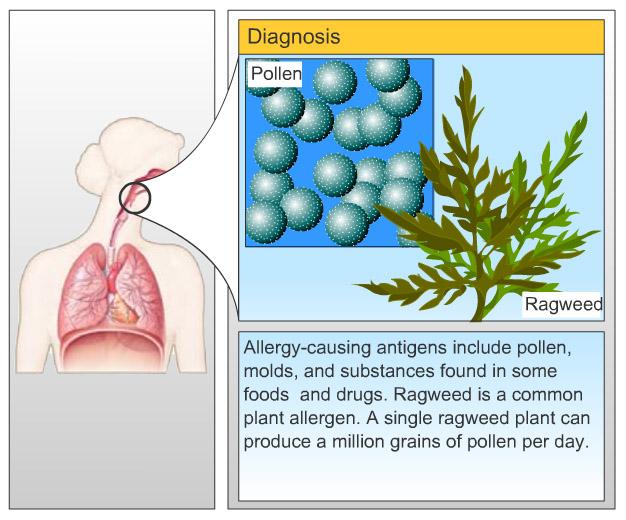 Asthma Allergies can trigger asthma.