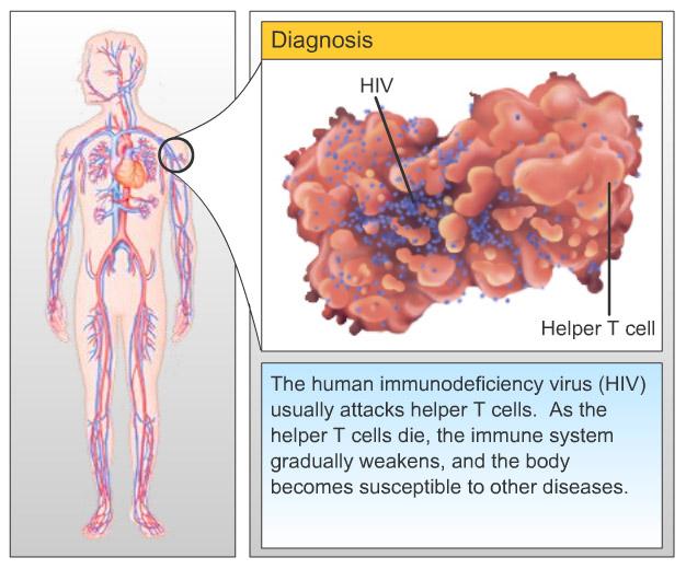 The Course of HIV Infection AIDS (acquired immunodeficiency syndrome)