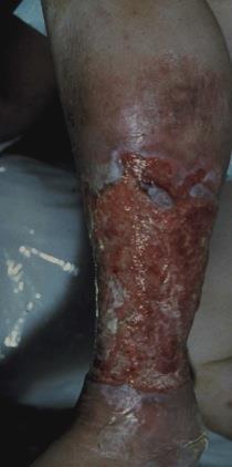 Reason for early clot removal: Relief of acute symptoms Swelling Pain Edema Risk reduction for
