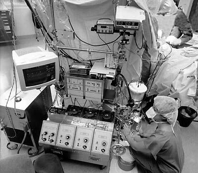 Heart Lung Machine Heart Lung Machine CABG Effectiveness 2001: 516,000 CABG procedures performed Procedure takes 4-6 hours, 5-7 day hospital stay Grafts remain open & functioning for 10-15 yrs Little