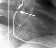 Angiography: Images Atherosclerosis and Heart Attacks Treatment of Acute Occlusion Treatment of Coronary Occlusions Introduced in Lecture 4 Thrombolytic drugs Angioplasty Stents Often in combination