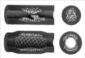 Treatment of Atherosclerosis: Stents A wire (typically) cage is inserted along with a