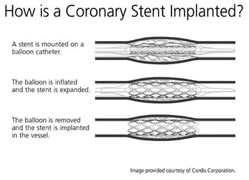 cells proliferate and grow over and around the stent Drug-Eluting Stents Slowly releases