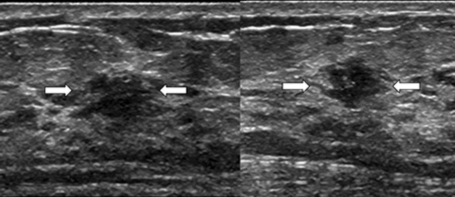 site. (B) Transverse (left) and longitudinal (right) scans of US reveal a microlobulated marginated, irregular shaped, hypoechoic mass (arrows).