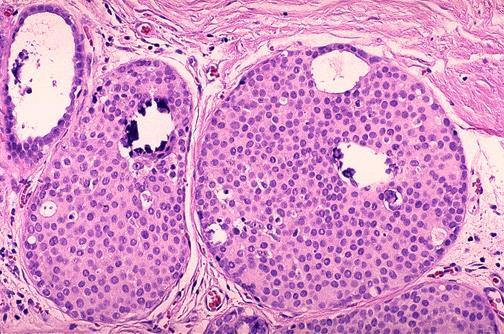 Ductal Carcinoma In Situ DCIS is a
