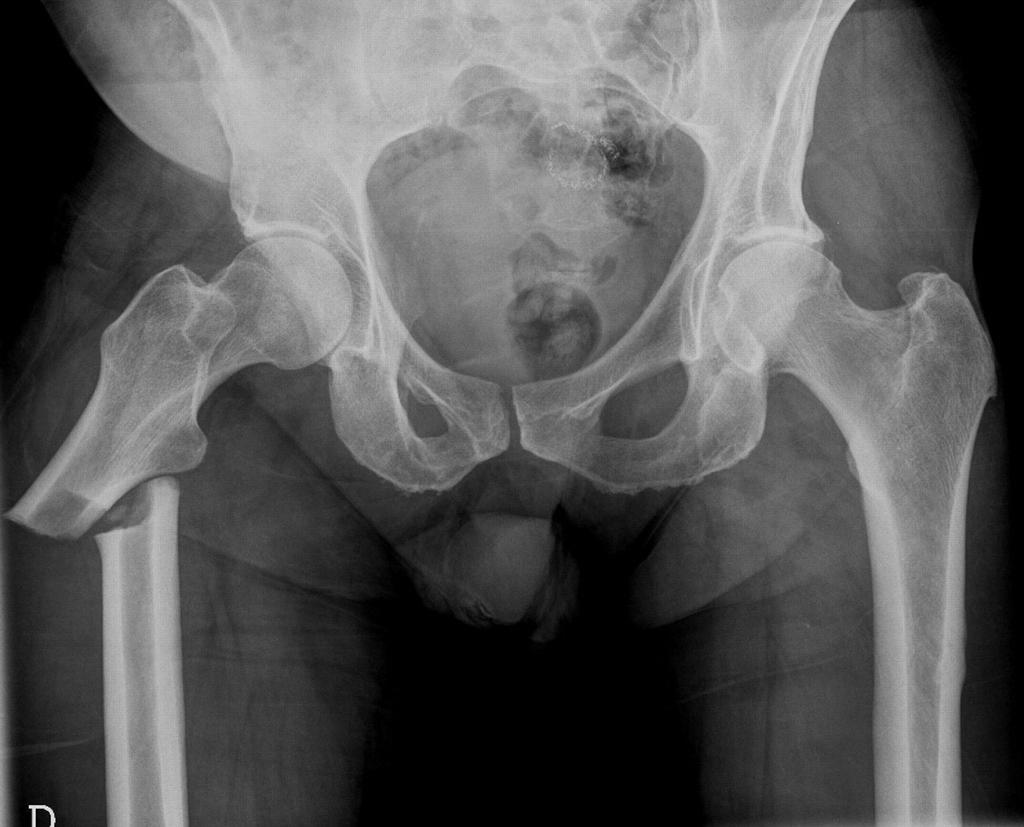 Atypical Femur Fractures Atypical Comparing Risks Unadjusted and Age-adjust e d Risk of AFF Accor ding to Dur ation of Bisphospho n at e Ther apy Fem ur Fr actur e Incidence of AFF per 1, per