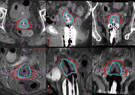 better visibility in MR, but MR CT MRI-guided insertions: NEEDLE GUIDANCE: tumor visualization needed NEEDLE VISIBILITY: