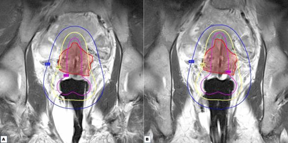 Image-based GYN Brachytherapy Insertion: SELECTION: brachytherapy technique GUIDANCE: applicator positioning, needle insertion Dose Evaluation: