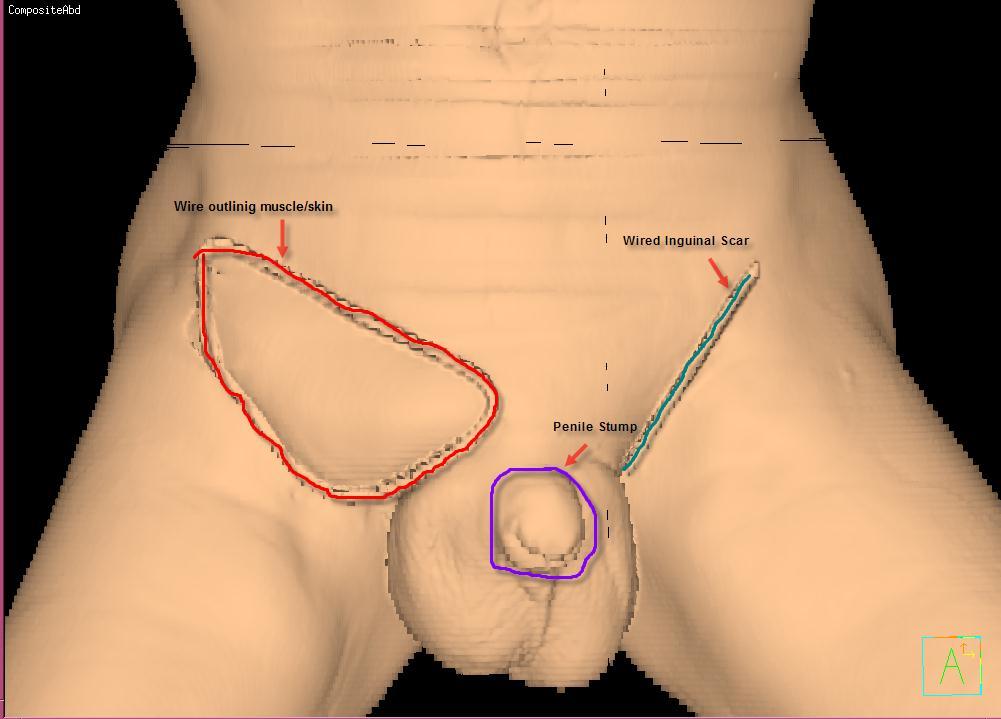 11 Figure 10: Bolus placement over penile stump Figure 11: Wire outlining