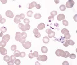 The buffy coat preparation seemed to have numerous Babesia inclusions in the WBCs, which gave a false impression of intracellular infection.