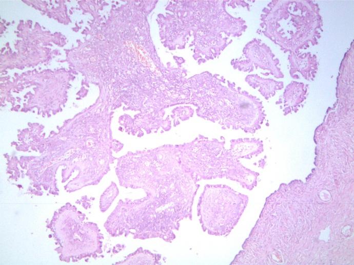 Introduction Diagnosis of Borderline papillary serous tumor of the fallopian tube was comprehensively established by Zheng in 1996 supported mostly by a histological similarity to its ovarian