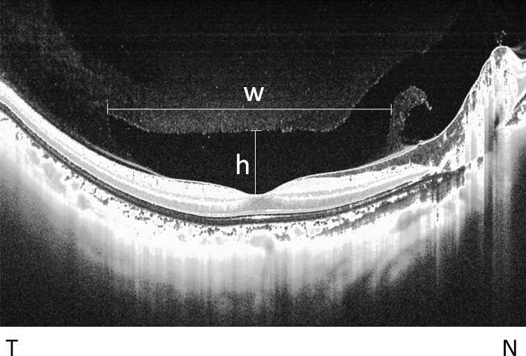 Posterior Precortical Vitreous Pocket Observation IOVS j May 2013 j Vol. 54 j No. 5 j 3103 FIGURE 1. Measurement of the PPVP in the right eye of a 25-year-old woman.