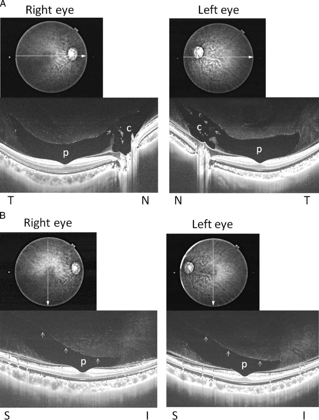 Posterior Precortical Vitreous Pocket Observation IOVS j May 2013 j Vol. 54 j No. 5 j 3104 FIGURE 2. Symmetrical posterior PPVPs were seen in both eyes of a 24-year-old woman.