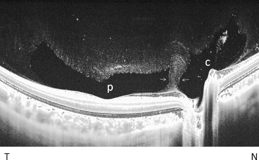 Posterior Precortical Vitreous Pocket Observation IOVS j May 2013 j Vol. 54 j No. 5 j 3106 FIGURE 4. The case of the right eye of a 26-year-old woman with 0.25 D of refractive error.
