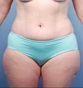 Stephen Mulholland Energy-assisted Liposuction Over roughly the last 20 years surgeons have directed much attention toward technologies that apply some form of energy to the fat tissue prior to