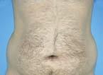 But the advantages of RFAL offer surgeons the ability to enhance the fat reduction in these areas and