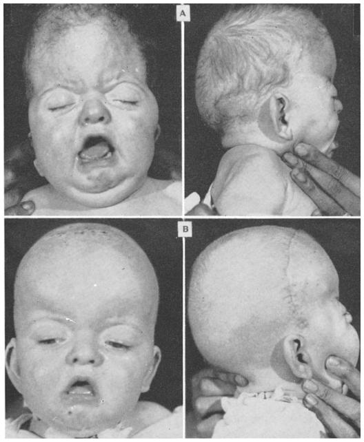 414 DONALD D. MATSON Fia. 1. (A) Anterior and lateral views of 4-month-old infant with coronal synostosis accompanied by widely patent metopic suture. (B) Postoperative appearance.