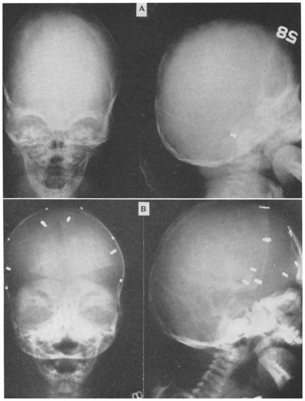TREATMENT OF ANOMALIES OF CRANIAL SUTURES 417 FIG. 4. (A) Anteroposterior and lateral roentgenograms of same patient as in Fig. 1. (B) Postoperative roentgenograms.