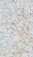 10-33% Staining APS = 3 PD-L1 Positive 66-100% Staining