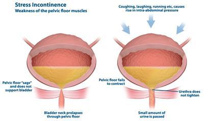 Genito-Urinary: Stress Incontinence Treatment Treat infection Pelvic floor exercise