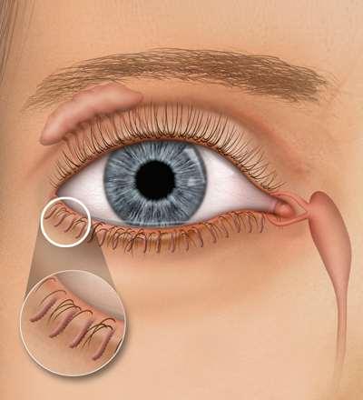 Blepharitis Leads to DED Staphylococcus A strains hydrolyze cholesteryl oleate (1) Change in viscosity of the meibum can block the ducts (2) Ocular rosacea (3) Styes (4) 1) Dougherty JM, McCulley JP.