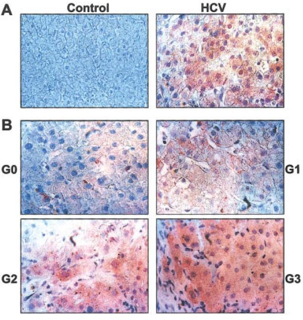 Role of apoptosis in pathogenesis of HCV-associated liver inflammation Serum concentration of caspase-cleaved CK-18 epitop M30 and inflammatory activity in liver biopsies in CHC