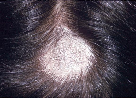 Typical M. canis scalp lesion showing hair loss and scaling.