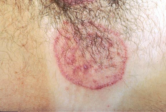 1-Tinea Corporis Tinea corporis is a superficial dermatophyte infection of the glabrous skin, excluding the scalp,