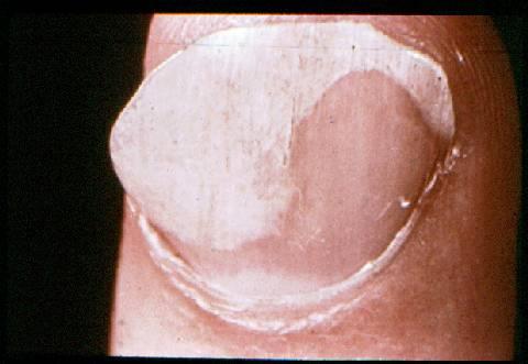 Toenails more often infected than fingernails. Infection often follows infection of another body site.