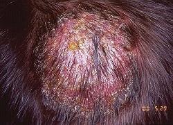 Tinea capitis (ring worm of the