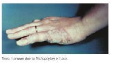 8-Tinea Manuum Tinea manuum is a rare form that primarily affects the palmar areas of