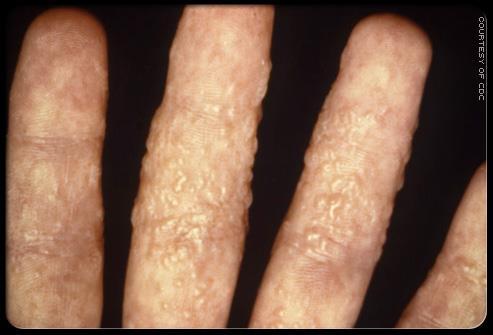 erythema. Infections are most frequently caused by T. rubrum.