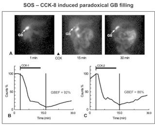 Gerbail T. Krishnamurthy et al Figure 3: Reproducibility of gallbladder paradoxical filling in a patient with sphincter of Oddi spasm.