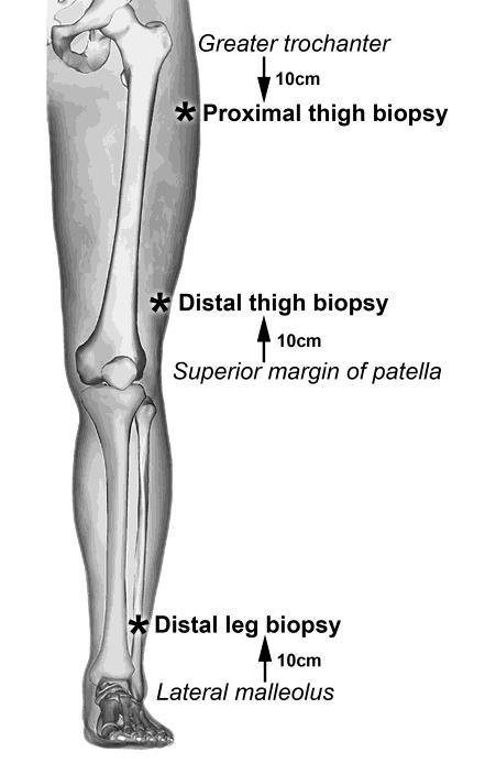 Biopsy Sites - There are three standard biopsy sites for length-dependent sensory polyneuropathy. All three are located on the lateral leg and have well-established, given normative values.