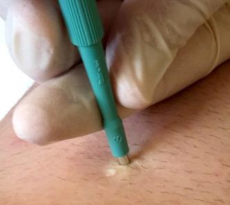 Step 4: Excise the Biopsy Wipe away excess blood with sterile gauze to visualize the biopsy.